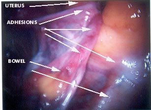 Adhsions woman's organs