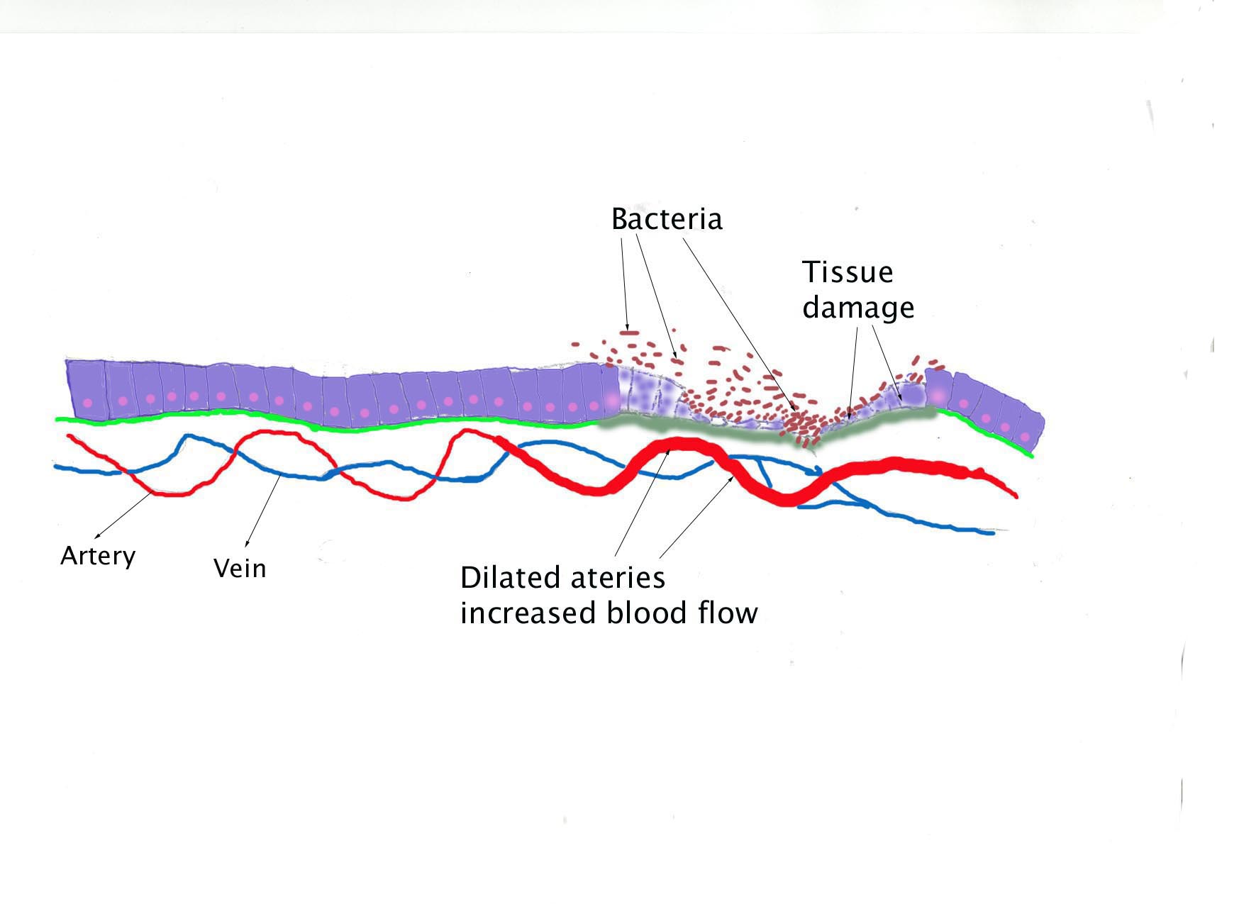 Bacteria causes tissue detruction