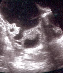 Cystic ovarian cancer