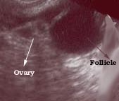 NormalOvaryWithFollicle