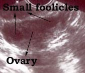 Normal ovary