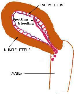 BreakthroughBleeding
