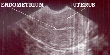 Sonar foto endometrium