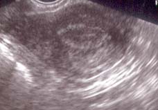 Sonar foto endomtrium